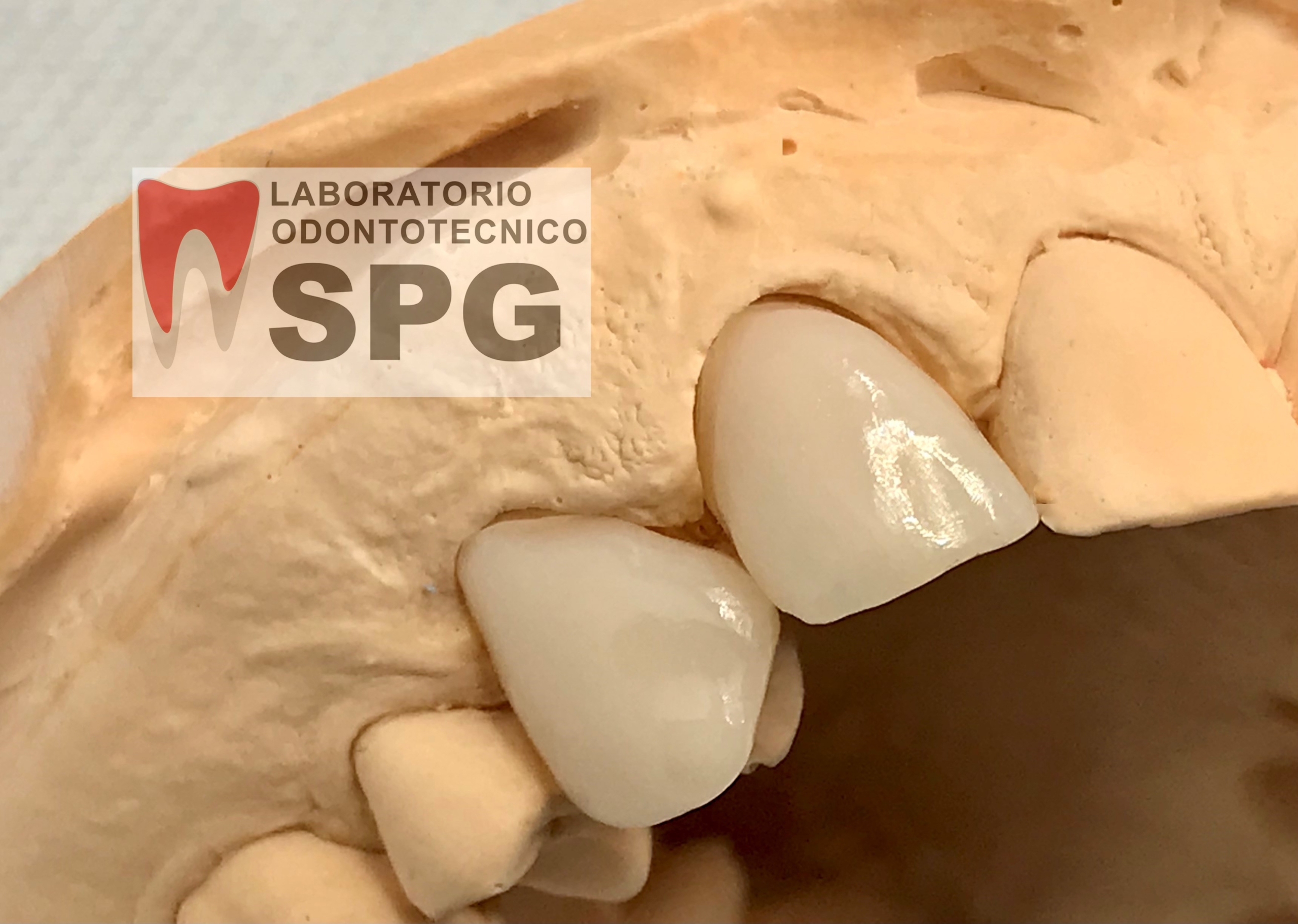 Faccette dentali SPG laboratorio odontotecnico a Brescia