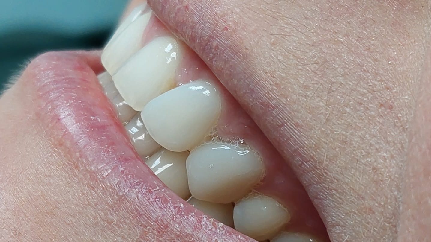 Faccette dentali SPG laboratorio odontotecnico a Brescia